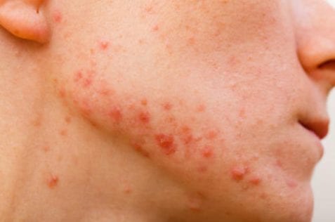 25769385 - acne skin because the disorders of sebaceous glands productions