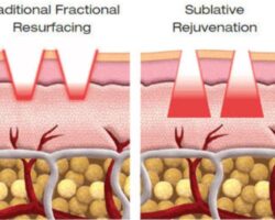 Skin Resurfacing