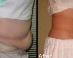 Cellulite Velashape