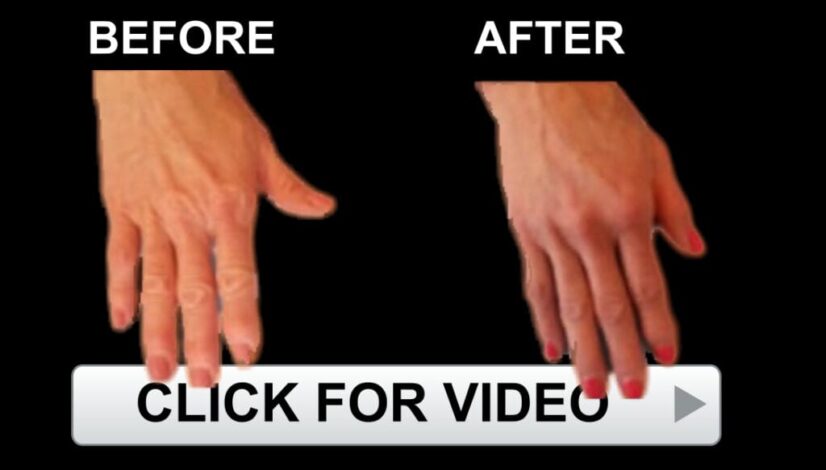 Hand Rejuvenation